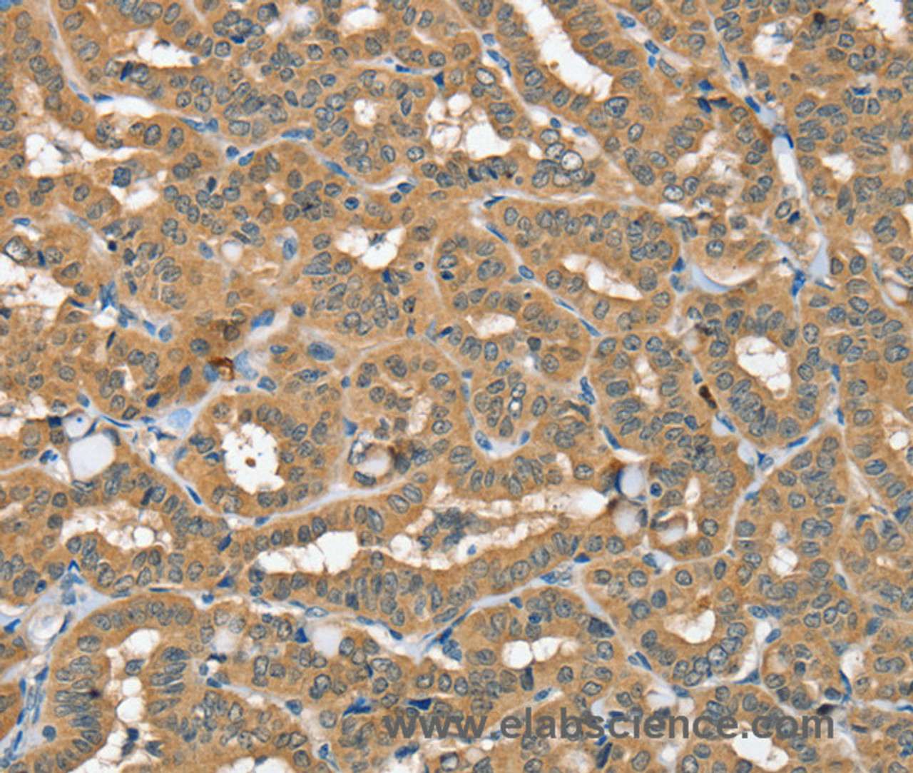 Immunohistochemistry of paraffin-embedded Human thyroid cancer using SEC14L2 Polyclonal Antibody at dilution of 1:40