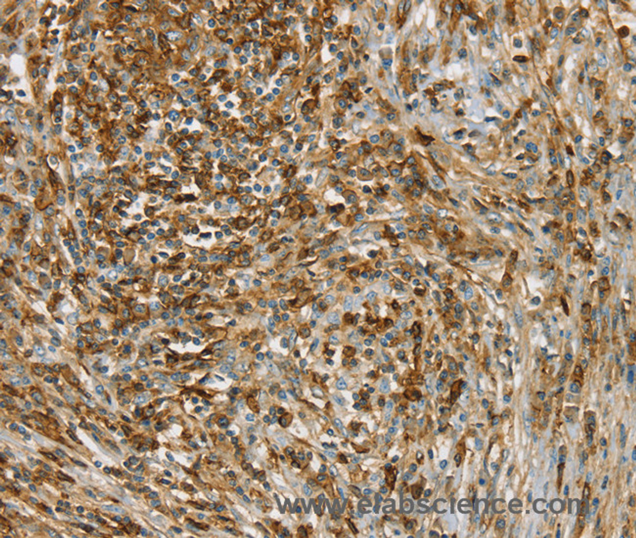 Immunohistochemistry of paraffin-embedded Human cervical cancer using SIK1 Polyclonal Antibody at dilution of 1:40