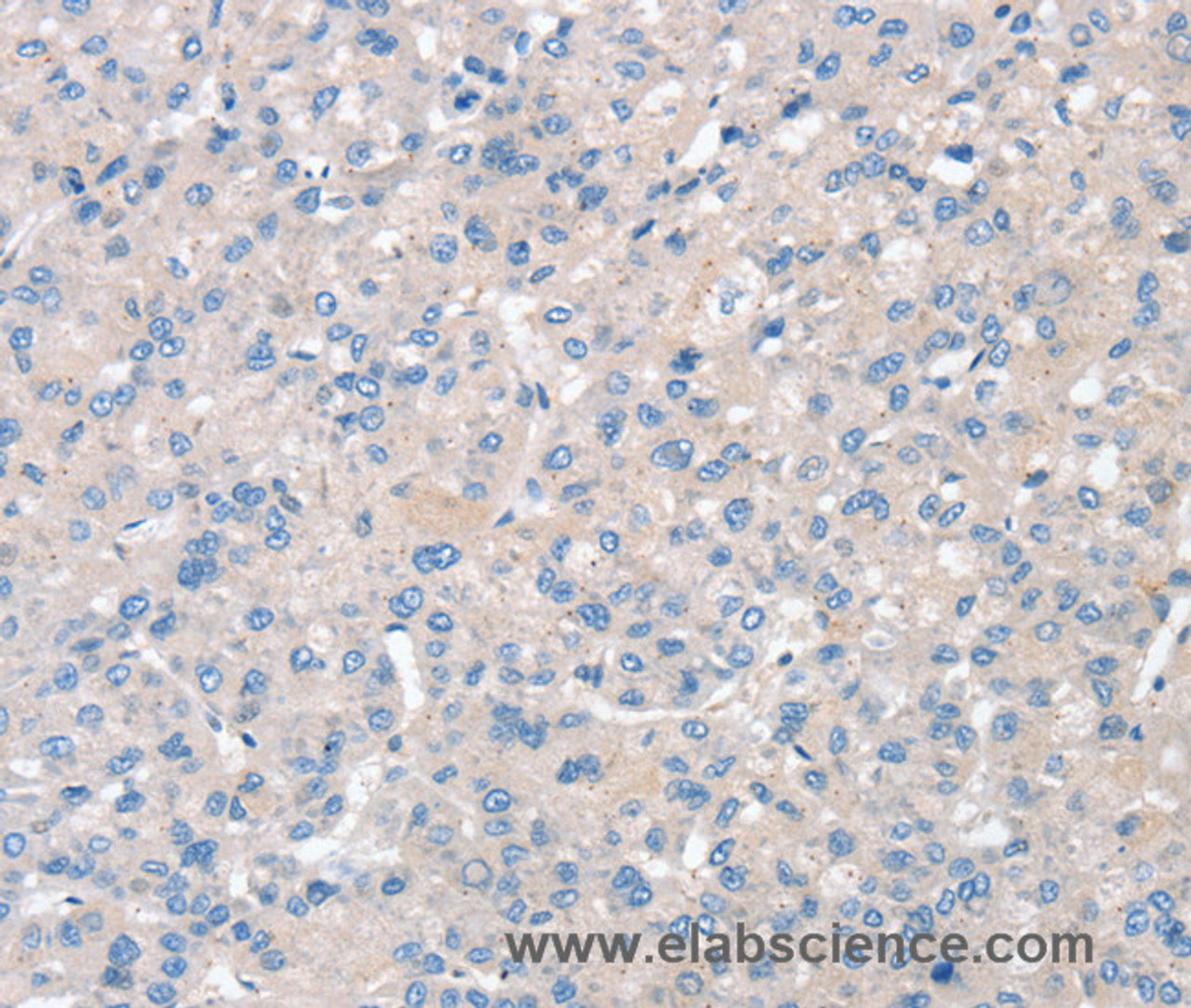 Immunohistochemistry of paraffin-embedded Human liver cancer using SNX3 Polyclonal Antibody at dilution of 1:30