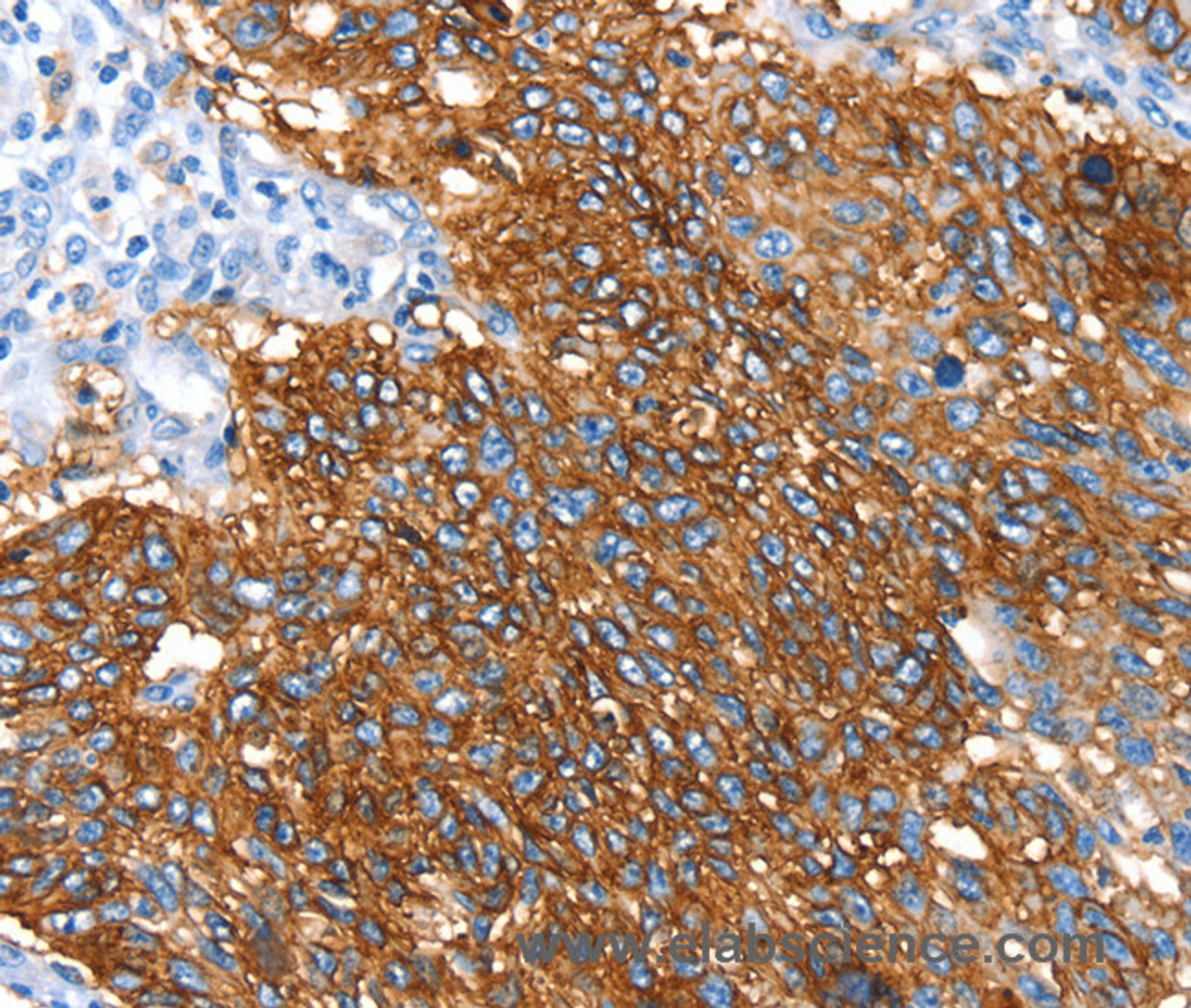 Immunohistochemistry of paraffin-embedded Human lung cancer using SNX5 Polyclonal Antibody at dilution of 1:30