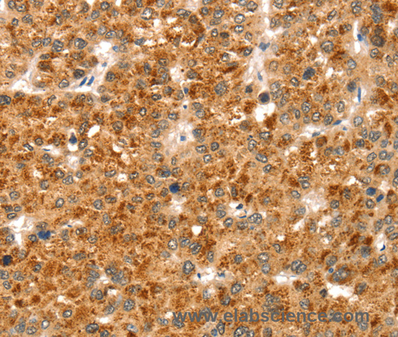 Immunohistochemistry of paraffin-embedded Human liver cancer using CCS Polyclonal Antibody at dilution of 1:35