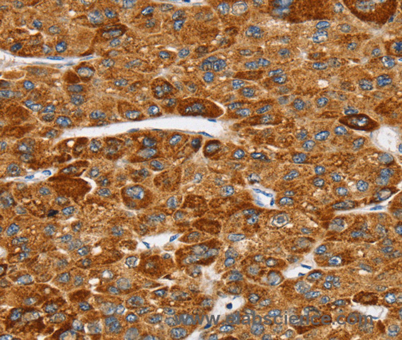 Immunohistochemistry of paraffin-embedded Human liver cancer tissue using SPARCL1 Polyclonal Antibody at dilution 1:30