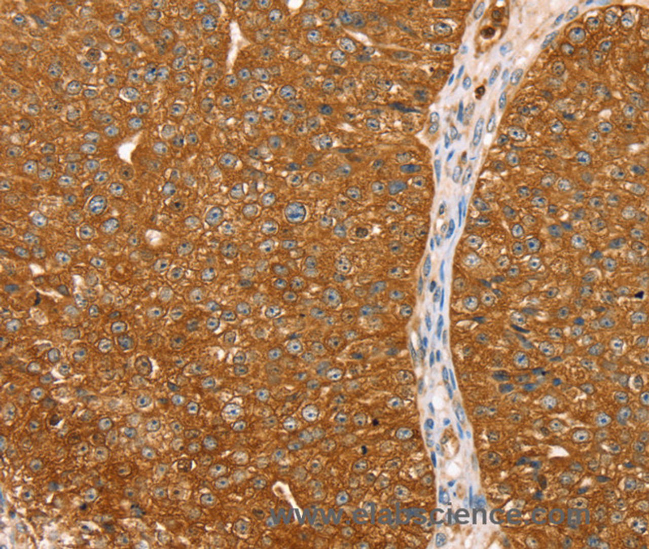 Immunohistochemistry of paraffin-embedded Human breast cancer tissue using ABCC8 Polyclonal Antibody at dilution 1:40