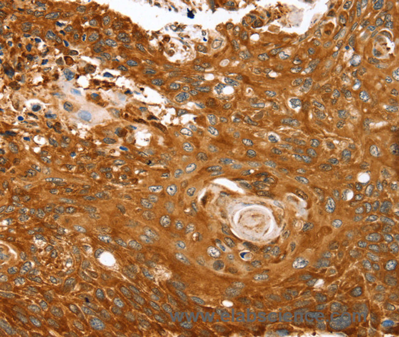 Immunohistochemistry of paraffin-embedded Human esophagus cancer tissue using ABCC8 Polyclonal Antibody at dilution 1:40