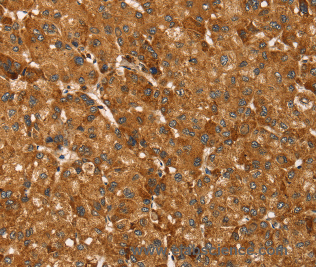 Immunohistochemistry of paraffin-embedded Human liver cancer tissue using TBC1D1 Polyclonal Antibody at dilution 1:45