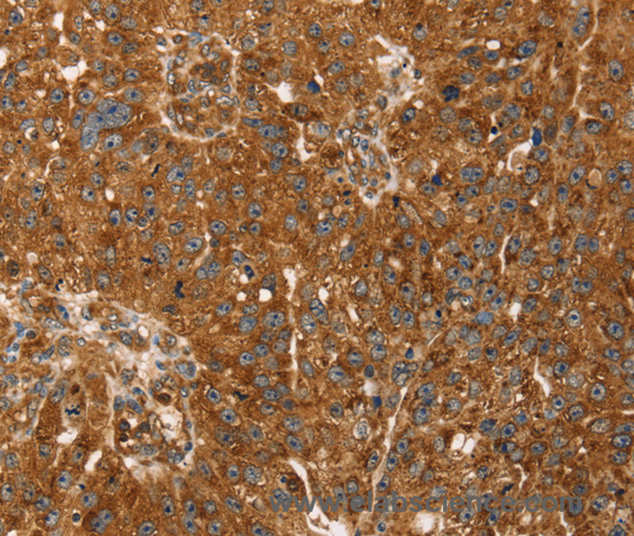 Immunohistochemistry of paraffin-embedded Human breast cancer tissue using TBC1D1 Polyclonal Antibody at dilution 1:45