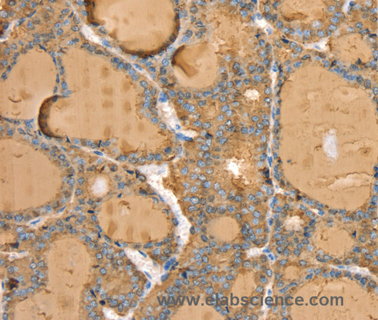 Immunohistochemistry of paraffin-embedded Human thyroid cancer tissue using TG Polyclonal Antibody at dilution 1:40