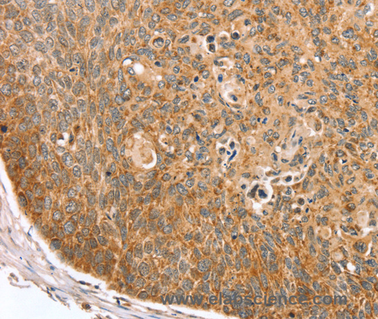 Immunohistochemistry of paraffin-embedded Human esophagus cancer using TRIM62 Polyclonal Antibody at dilution of 1:30