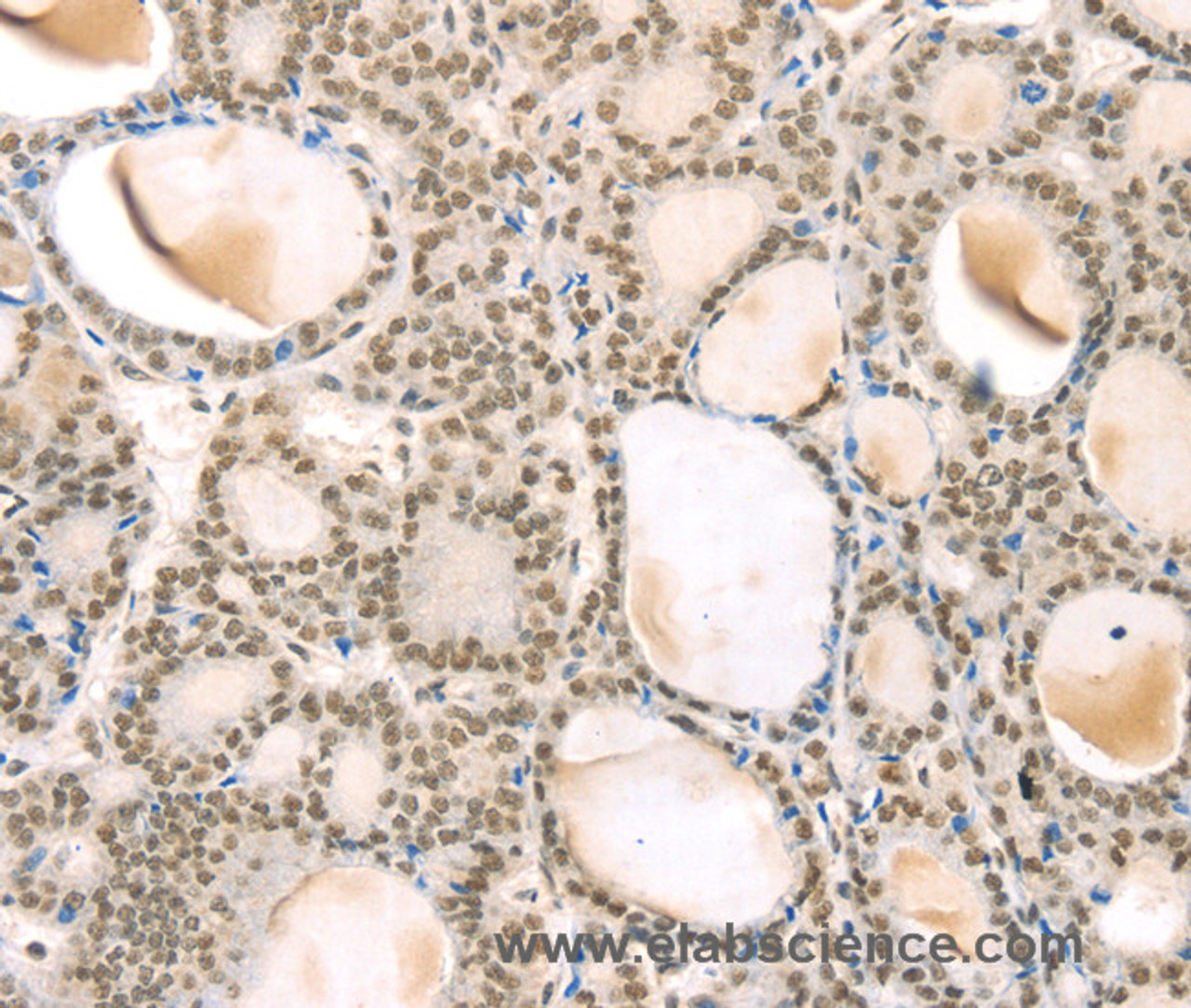 Immunohistochemistry of paraffin-embedded Human thyroid cancer using TSPAN13 Polyclonal Antibody at dilution of 1:35