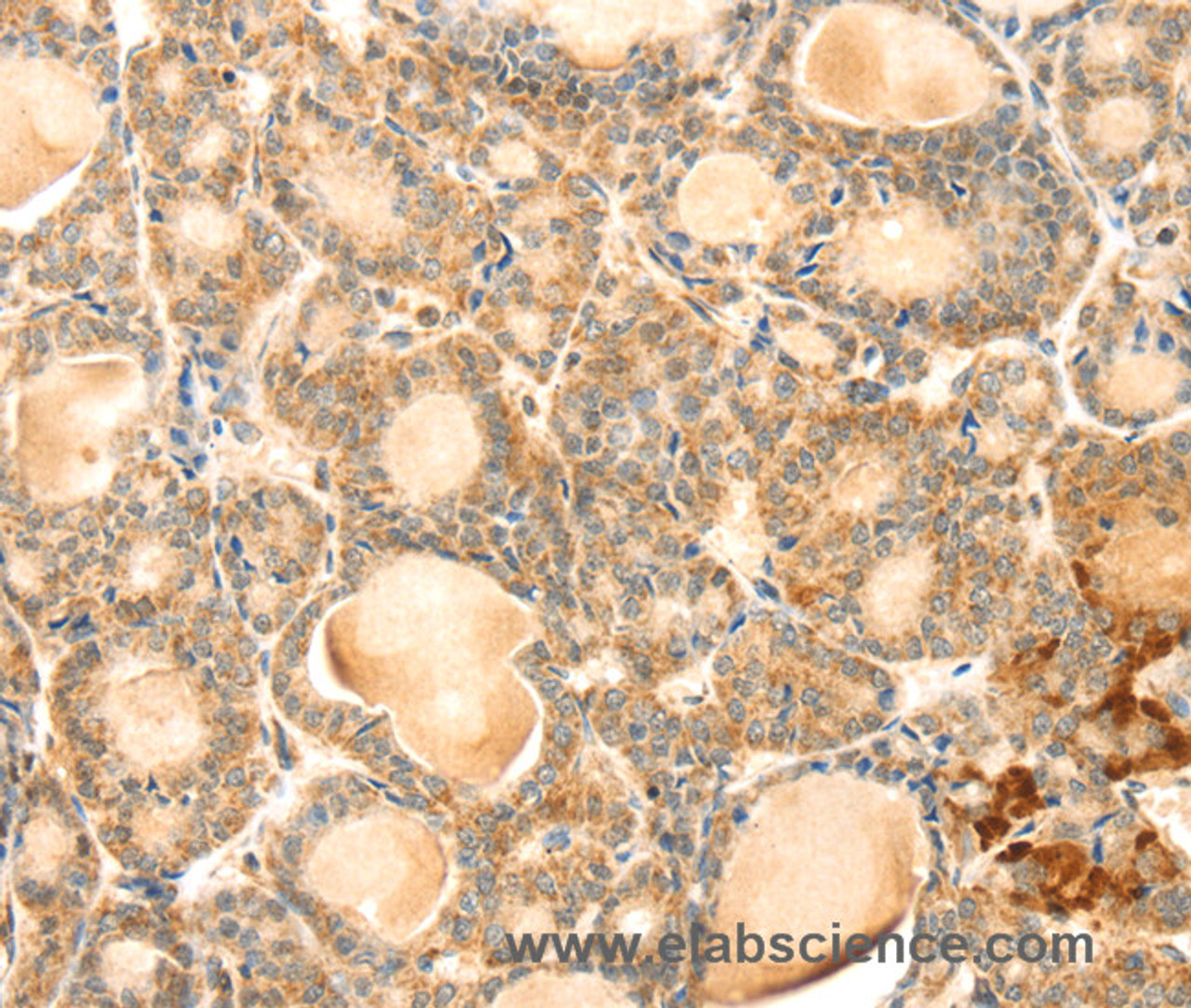Immunohistochemistry of paraffin-embedded Human thyroid cancer using EVA1A Polyclonal Antibody at dilution of 1:30