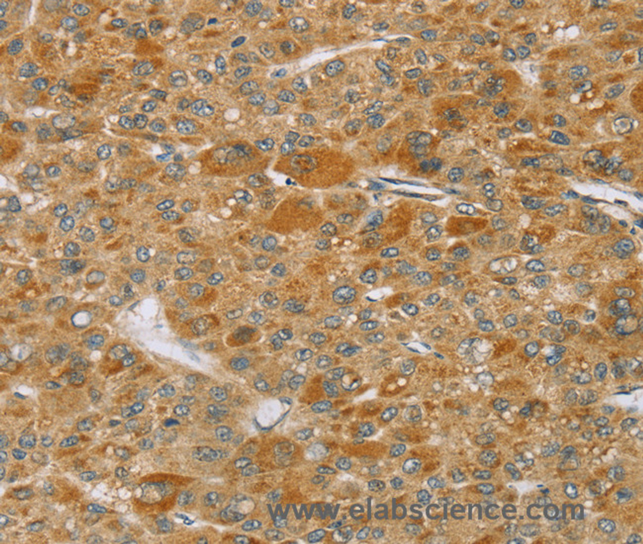Immunohistochemistry of paraffin-embedded Human liver cancer using TP53I11 Polyclonal Antibody at dilution of 1:40