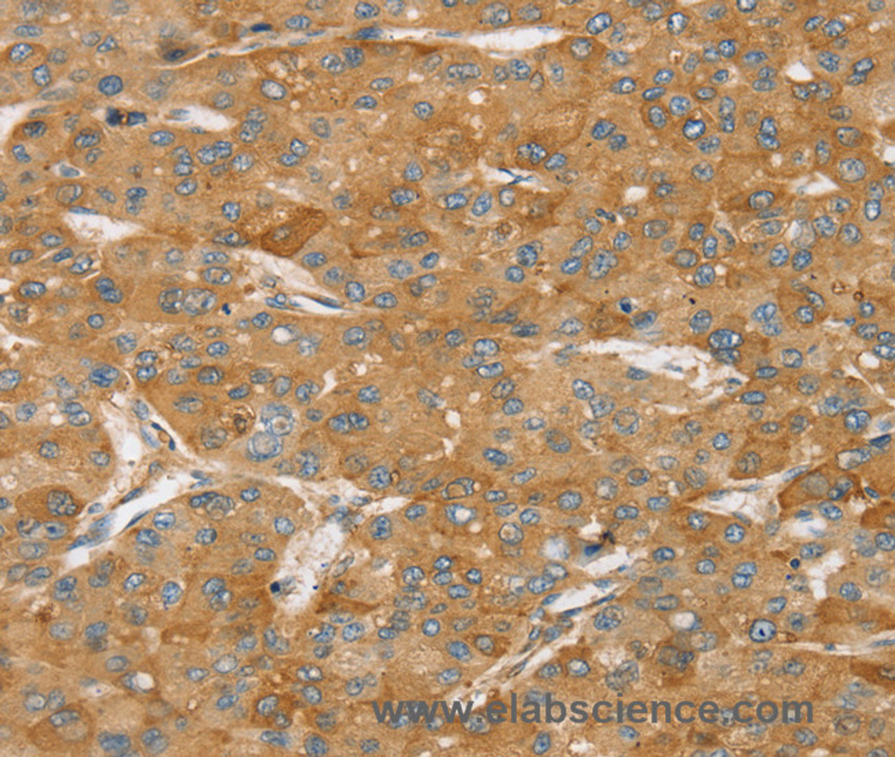 Immunohistochemistry of paraffin-embedded Human liver cancer using TPD54 Polyclonal Antibody at dilution of 1:35