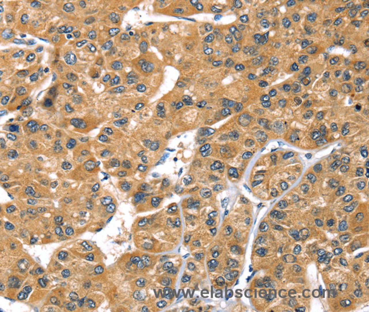 Immunohistochemistry of paraffin-embedded Human liver cancer using PRSS50 Polyclonal Antibody at dilution of 1:30