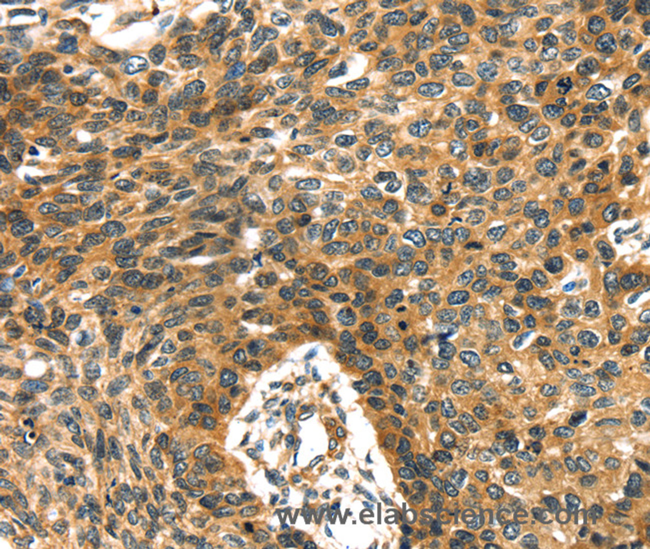 Immunohistochemistry of paraffin-embedded Human esophagus cancer using PRSS50 Polyclonal Antibody at dilution of 1:30