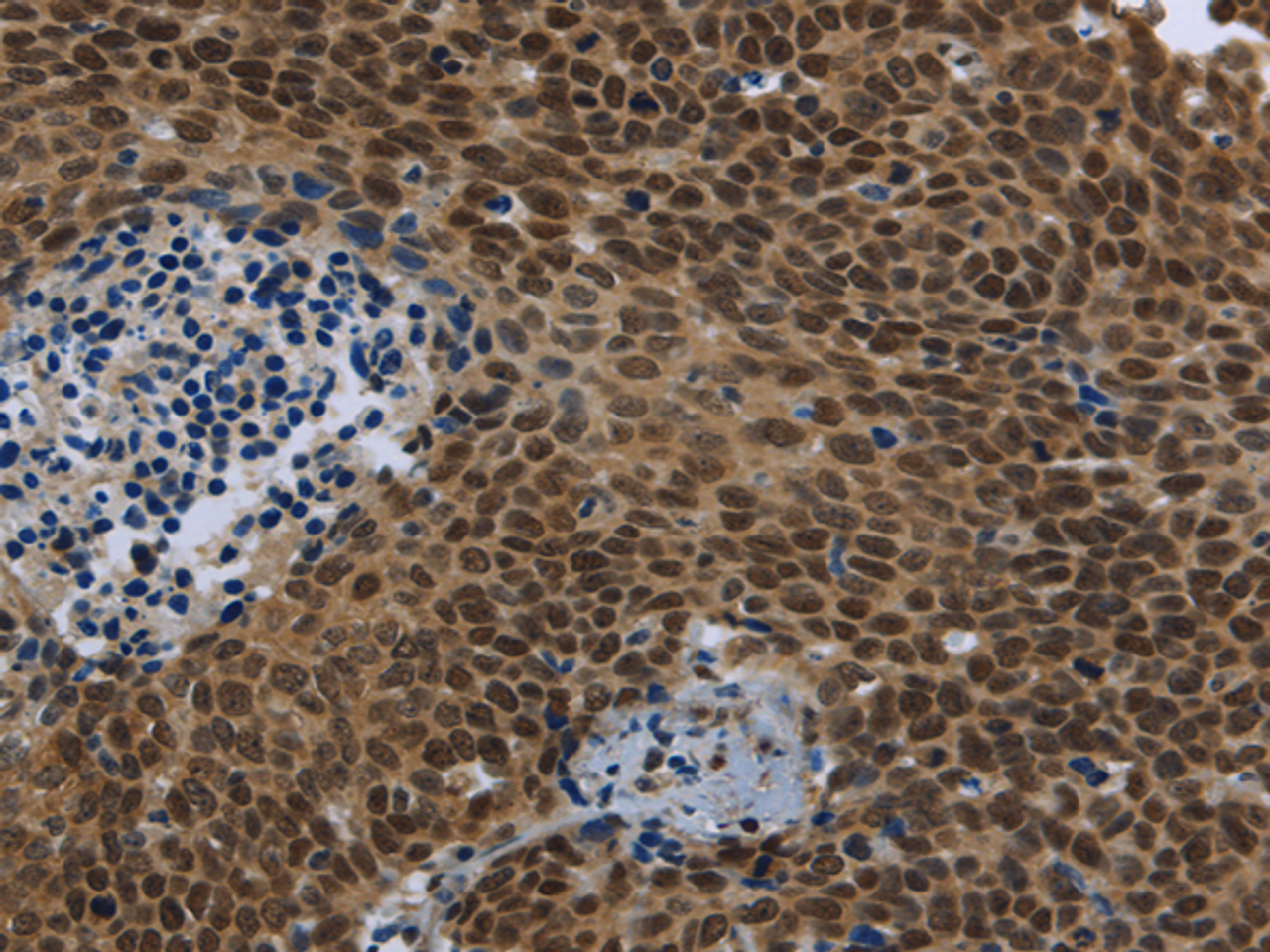 Immunohistochemistry of paraffin-embedded Human cervical cancer using SMAD4 Polyclonal Antibody at dilution of 1/40