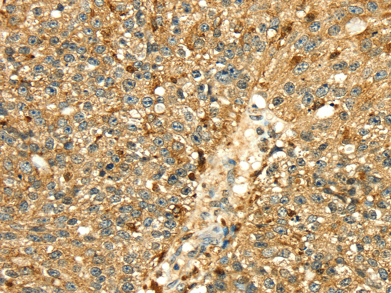 Immunohistochemistry of paraffin-embedded Human breast cancer tissue using Cathepsin H Polyclonal Antibody at dilution 1:50