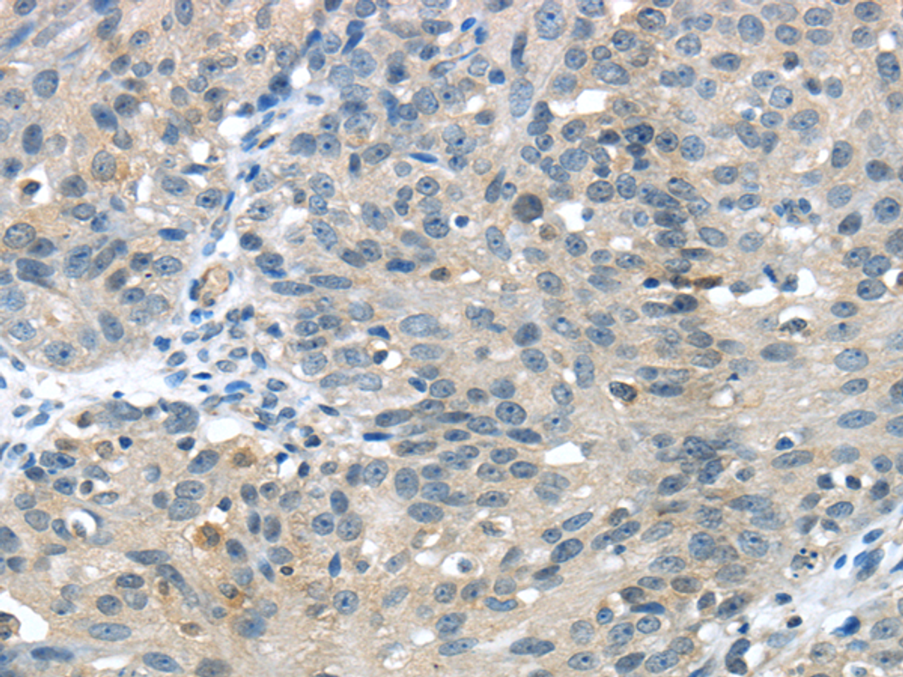Immunohistochemistry of paraffin-embedded Human breast cancer using GLP2R Polyclonal Antibody at dilution of  1/30