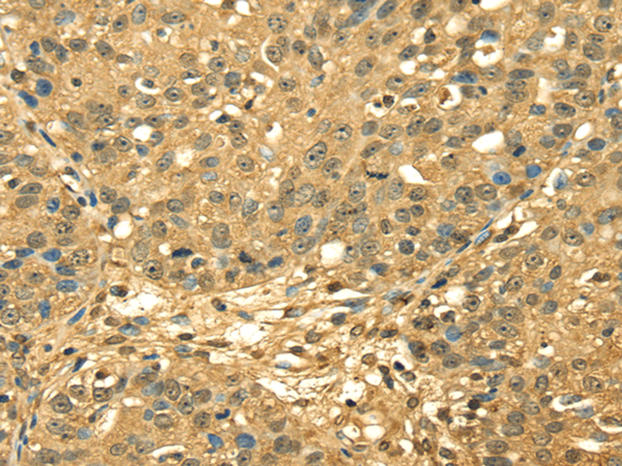 Immunohistochemistry of paraffin-embedded Human breast cancer using RPA2 Polyclonal Antibody at dilution of  1/45