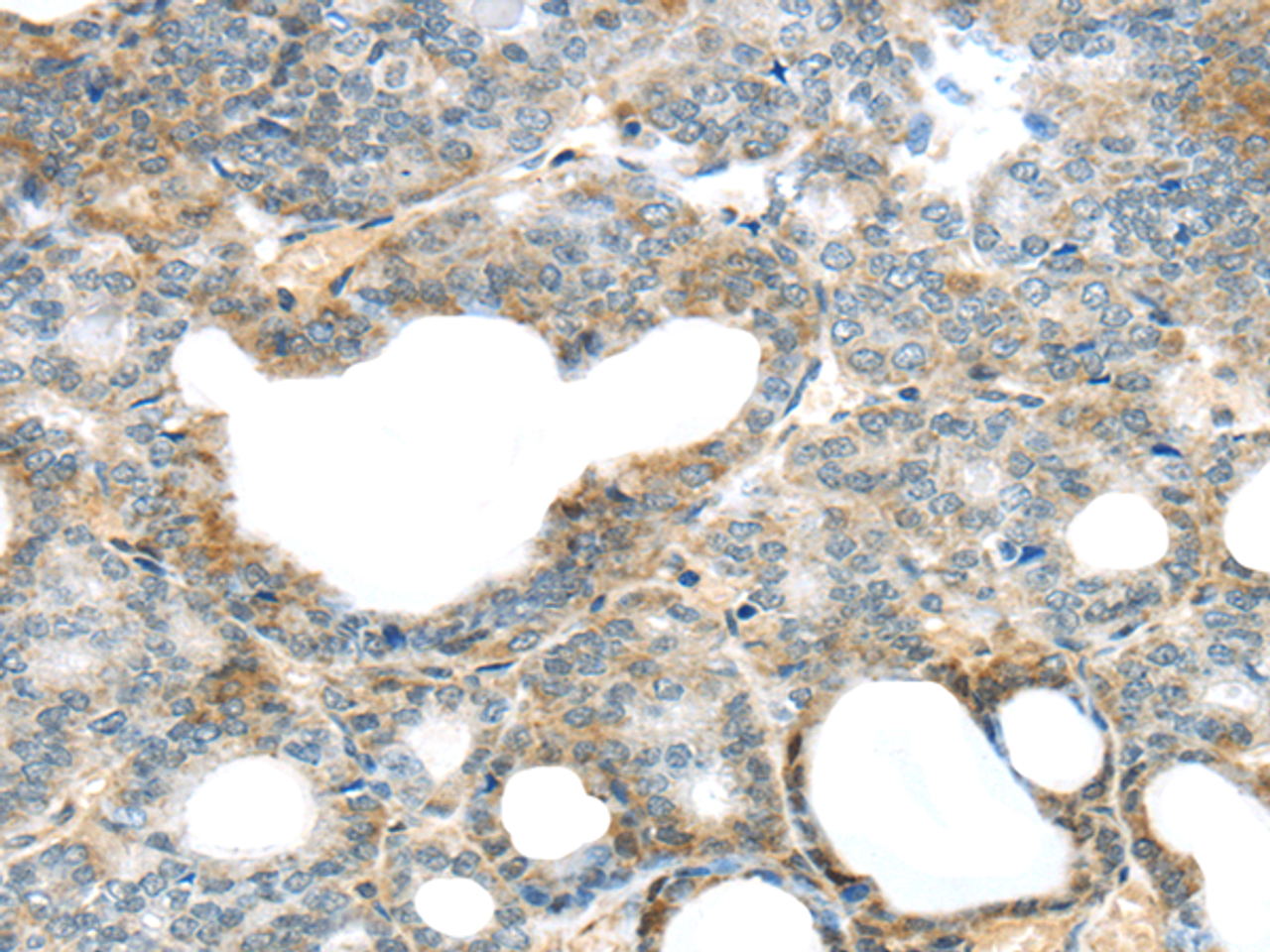 Immunohistochemistry of paraffin-embedded Human thyroid cancer using SERPINB11 Polyclonal Antibody at dilution of  1/20