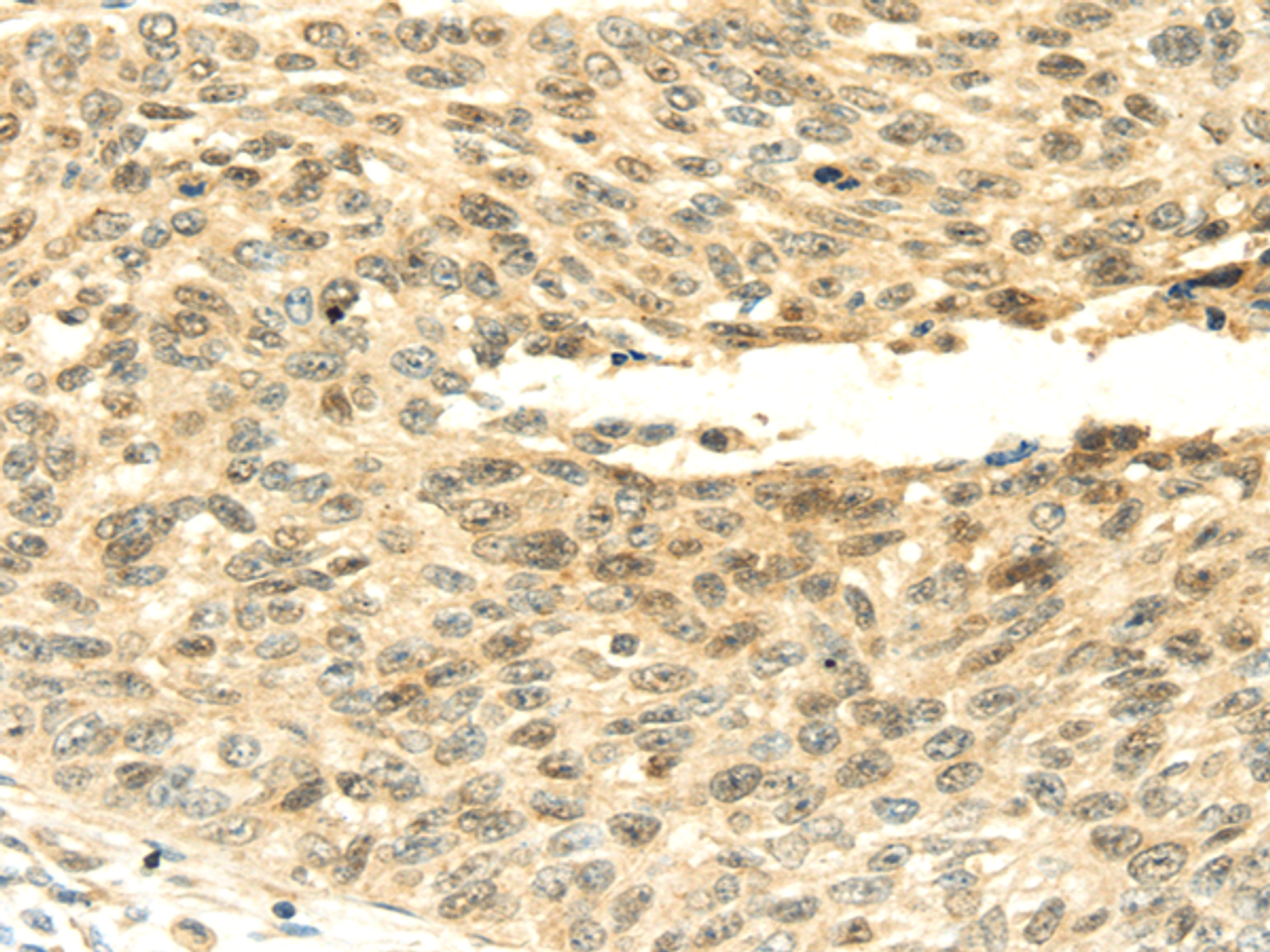 Immunohistochemistry of paraffin-embedded Human lung cancer tissue using SHPRH Polyclonal Antibody at dilution 1:45