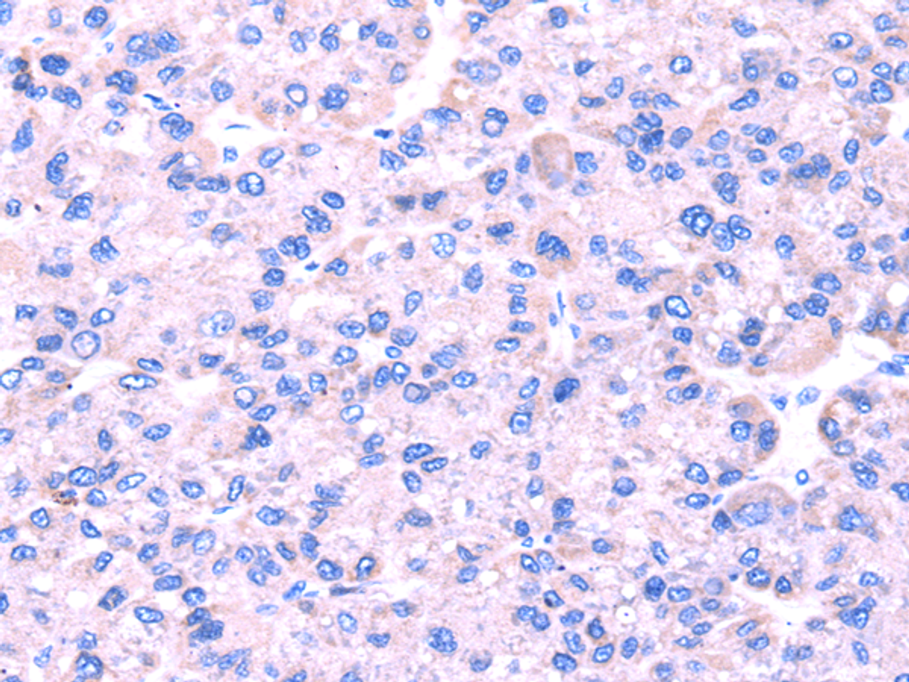 Immunohistochemistry of paraffin-embedded Human liver cancer using SRPK1 Polyclonal Antibody at dilution of  1/45