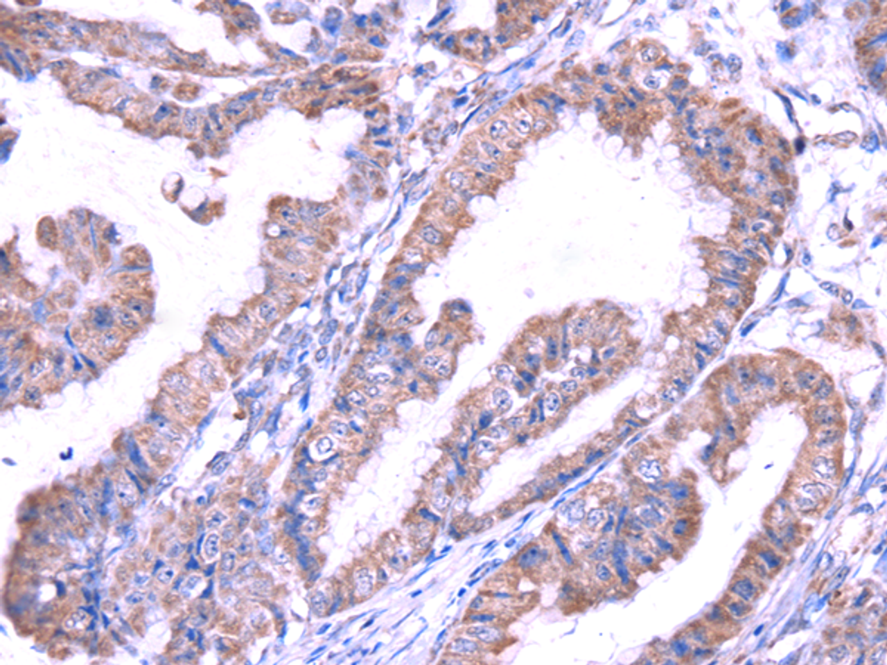 Immunohistochemistry of paraffin-embedded Human esophagus cancer using SRPK1 Polyclonal Antibody at dilution of  1/45