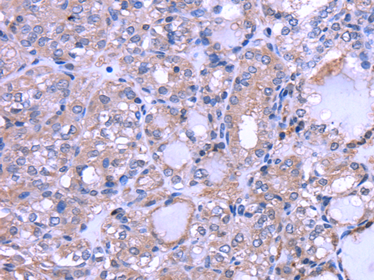 Immunohistochemistry of paraffin-embedded Human thyroid cancer using THRSP Polyclonal Antibody at dilution of  1/30