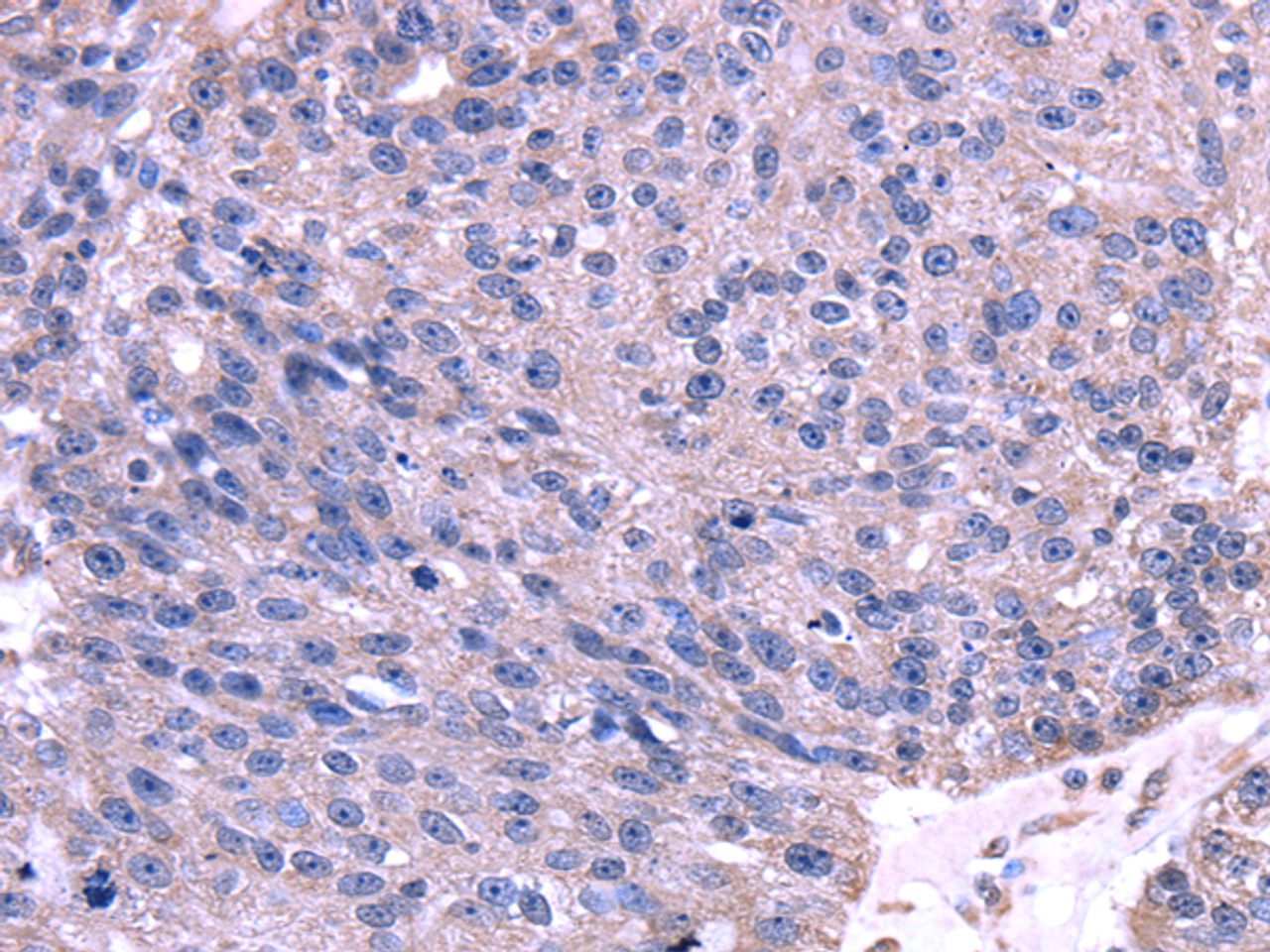 Immunohistochemistry of paraffin-embedded Human breast cancer using TRIM14 Polyclonal Antibody at dilution of  1/35