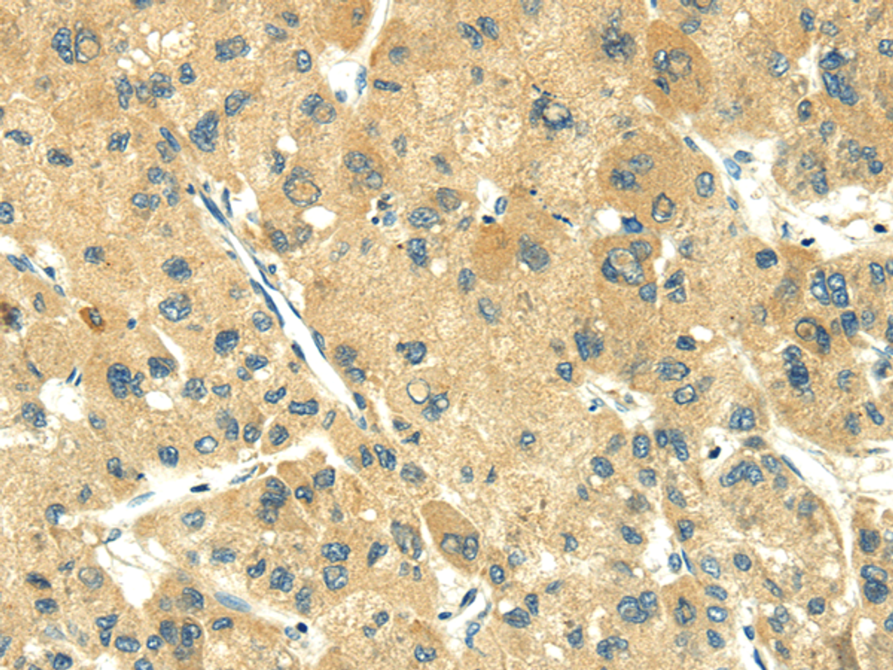 Immunohistochemistry of paraffin-embedded Human liver cancer using TRIM10 Polyclonal Antibody at dilution of  1/35