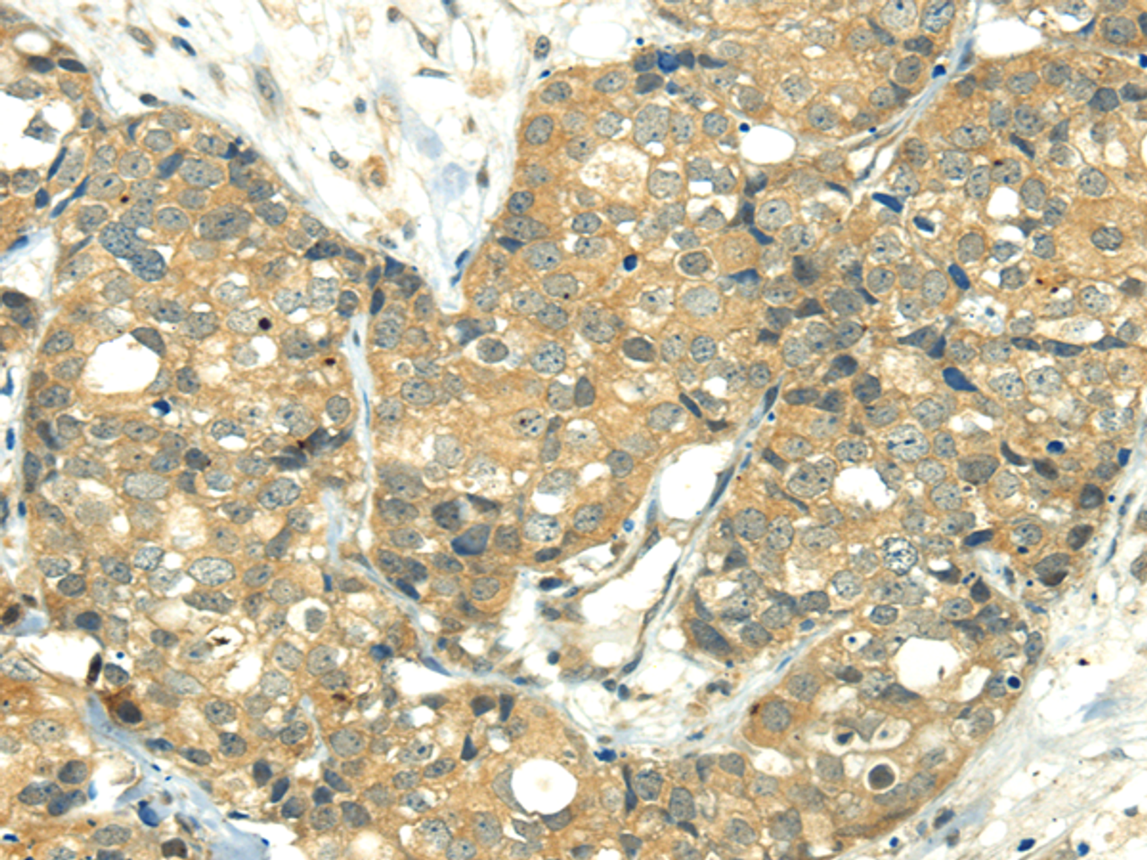 Immunohistochemistry of paraffin-embedded Human breast cancer using TRIM10 Polyclonal Antibody at dilution of  1/35