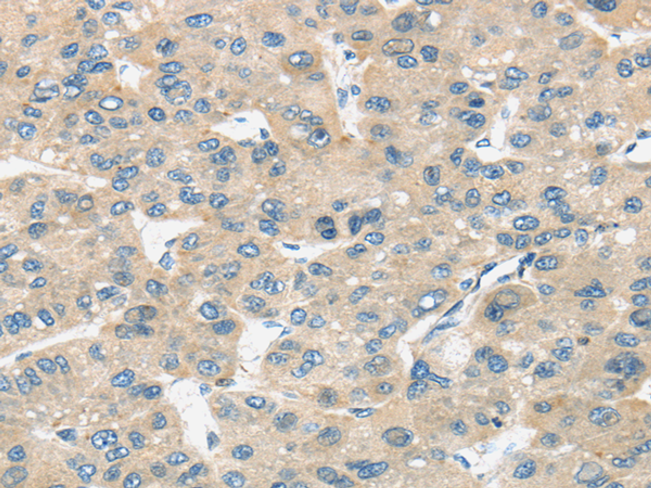 Immunohistochemistry of paraffin-embedded Human liver cancer tissue using TIRAP Polyclonal Antibody at dilution 1:30