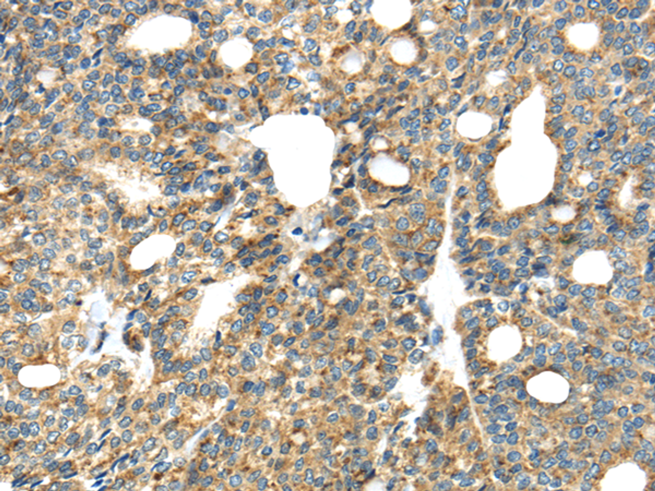 Immunohistochemistry of paraffin-embedded Human thyroid cancer tissue using TIRAP Polyclonal Antibody at dilution 1:30