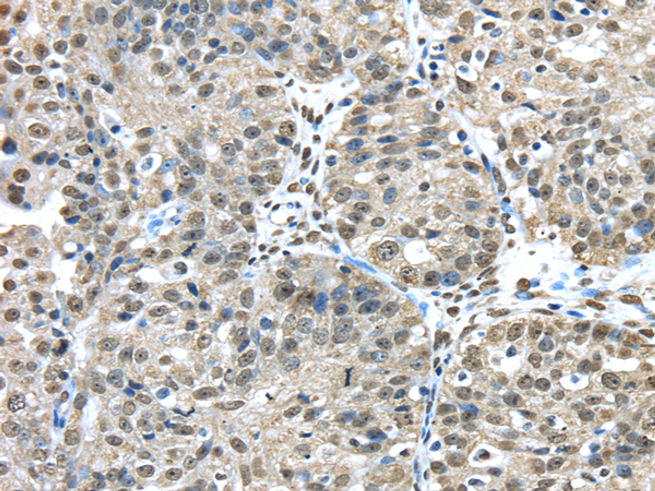 Immunohistochemistry of paraffin-embedded Human breast cancer tissue using FUS Polyclonal Antibody at dilution 1:45
