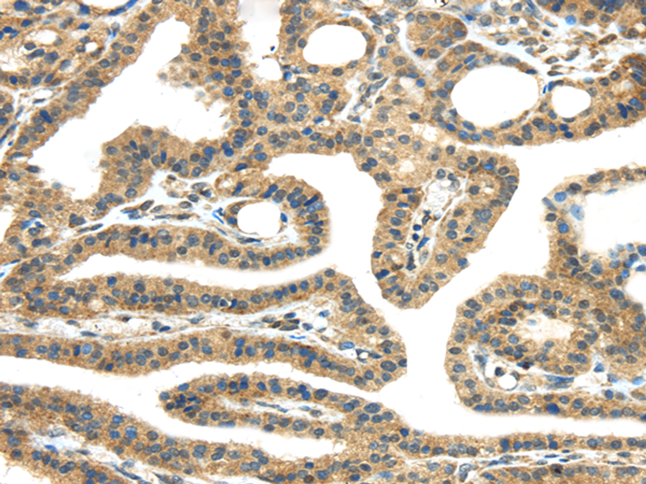 Immunohistochemistry of paraffin-embedded Human thyroid cancer tissue using TMPRSS11E Polyclonal Antibody at dilution 1:45