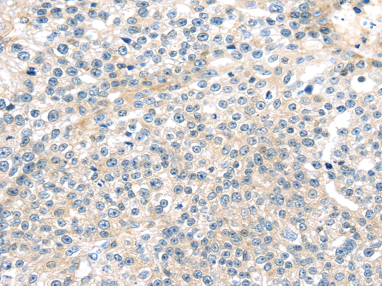 Immunohistochemistry of paraffin-embedded Human breast cancer tissue using TNFAIP8 Polyclonal Antibody at dilution 1:35