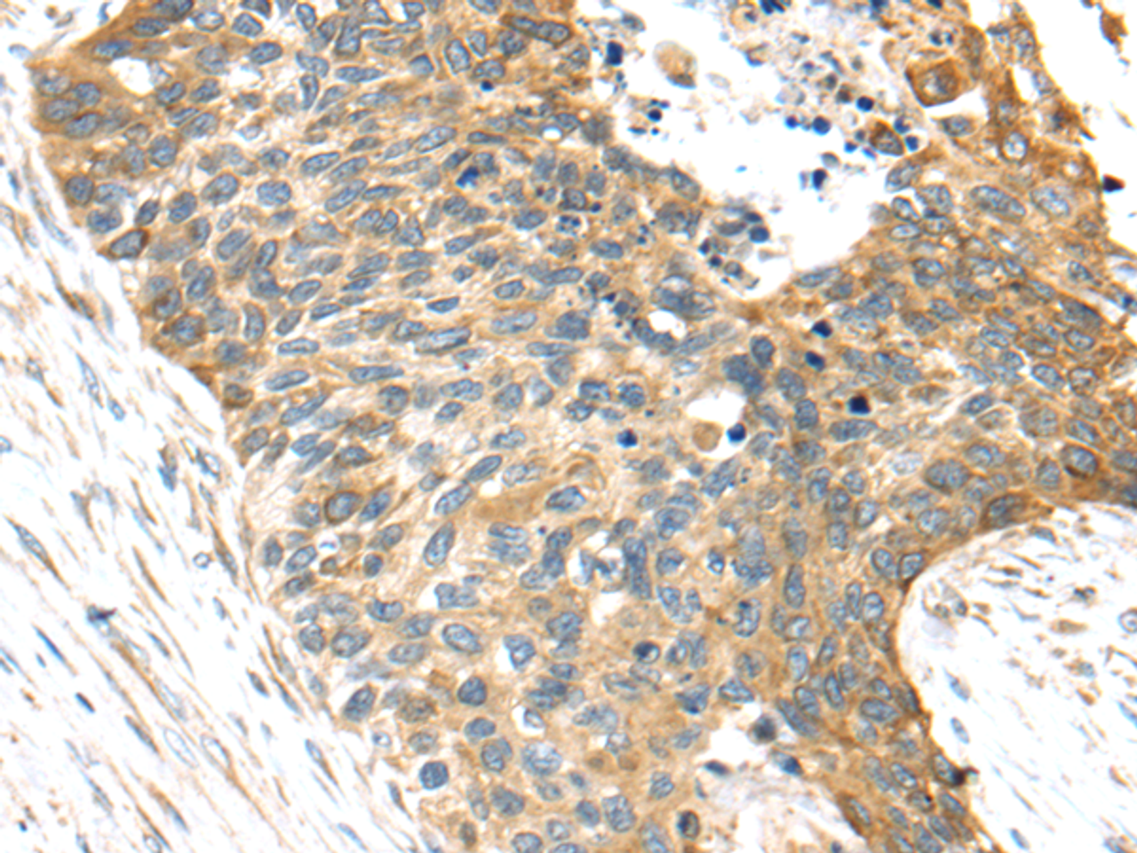 Immunohistochemistry of paraffin-embedded Human esophagus cancer tissue using TNFAIP8 Polyclonal Antibody at dilution 1:35