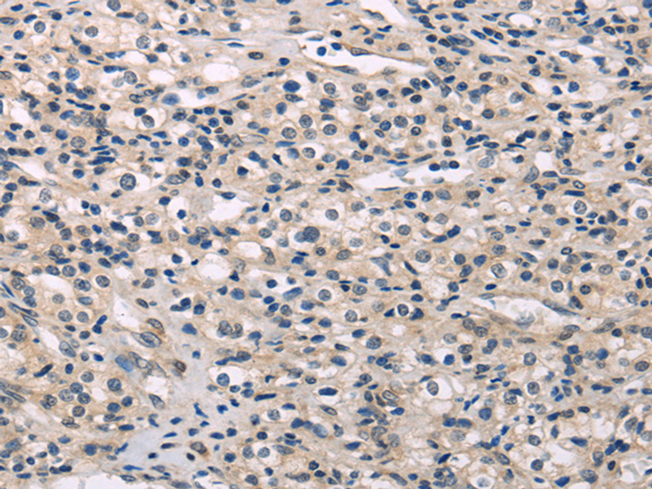 Immunohistochemistry of paraffin-embedded Human prostate cancer using MED28 Polyclonal Antibody at dilution of  1/30