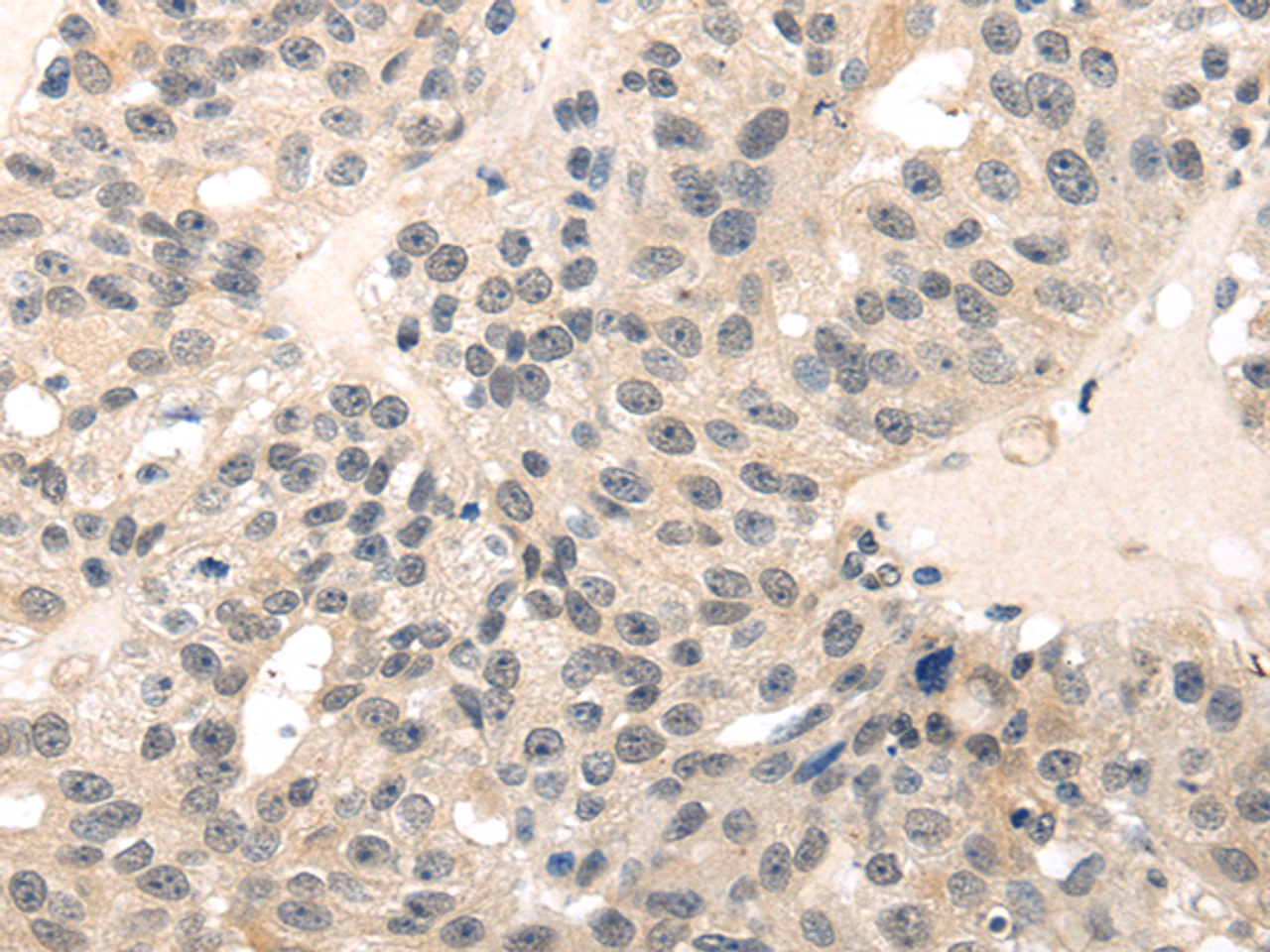 Immunohistochemistry of paraffin-embedded Human breast cancer using MED28 Polyclonal Antibody at dilution of  1/30