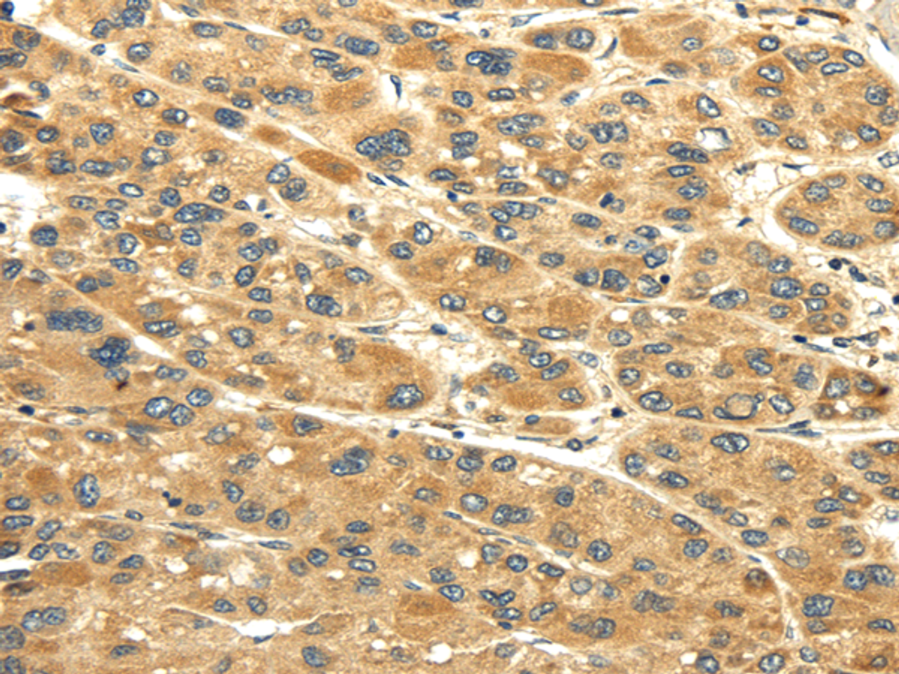 Immunohistochemistry of paraffin-embedded Human liver cancer tissue using UACA Polyclonal Antibody at dilution 1:45