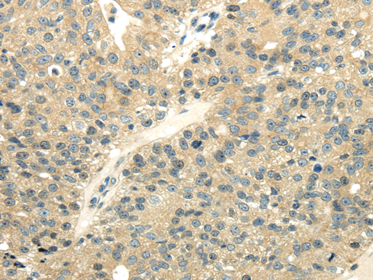 Immunohistochemistry of paraffin-embedded Human breast cancer using UBL4A Polyclonal Antibody at dilution of  1/40