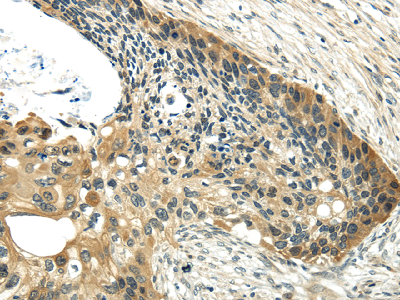 Immunohistochemistry of paraffin-embedded Human esophagus cancer using UBL4A Polyclonal Antibody at dilution of  1/40