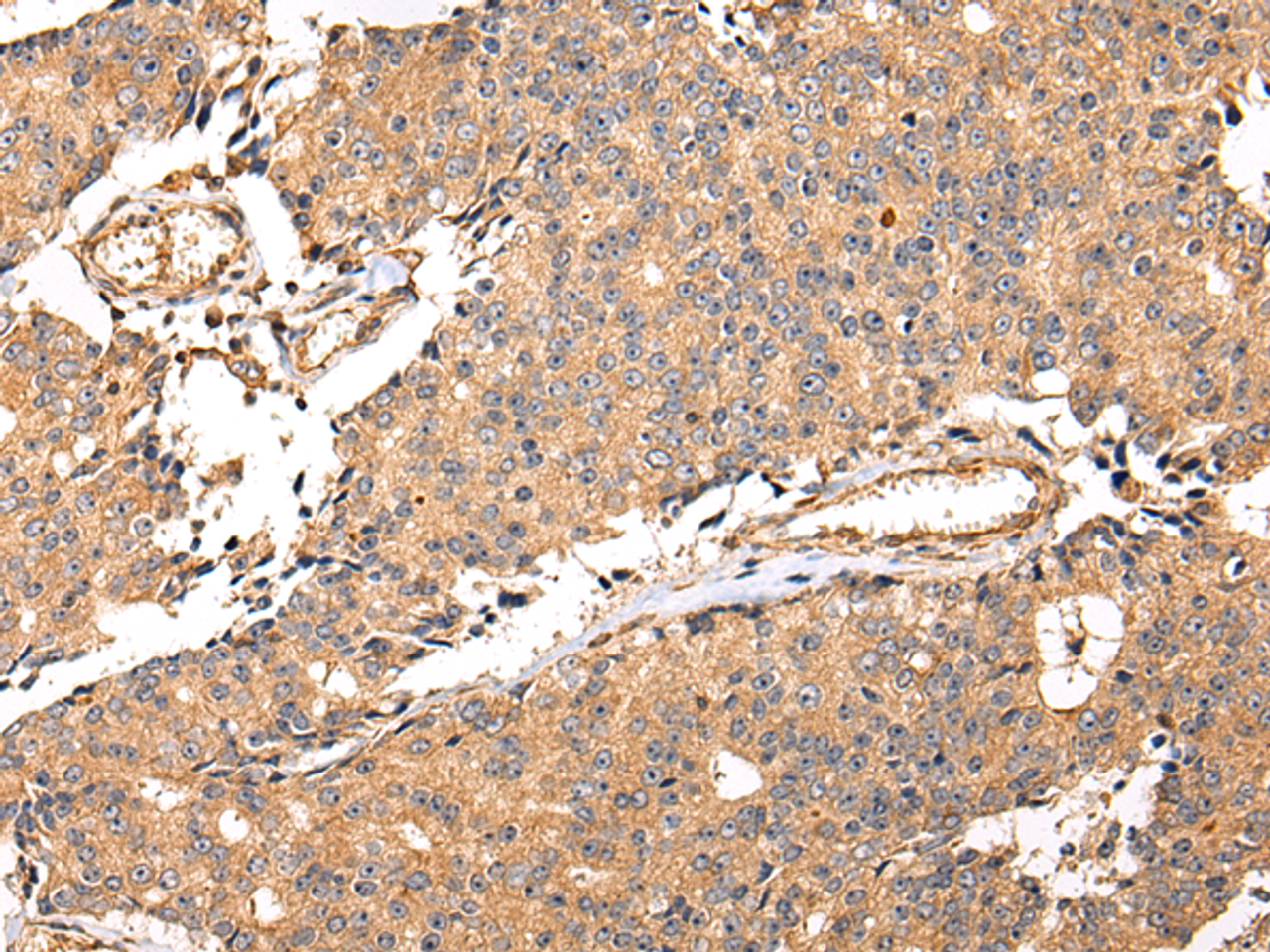 Immunohistochemistry of paraffin-embedded Human prostate cancer using ALDH3A2 Polyclonal Antibody at dilution of  1/20
