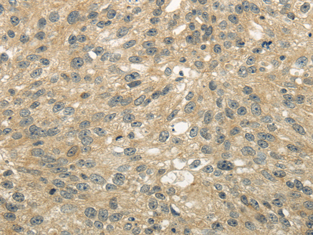Immunohistochemistry of paraffin-embedded Human breast cancer tissue using UGT2B4 Polyclonal Antibody at dilution 1:45
