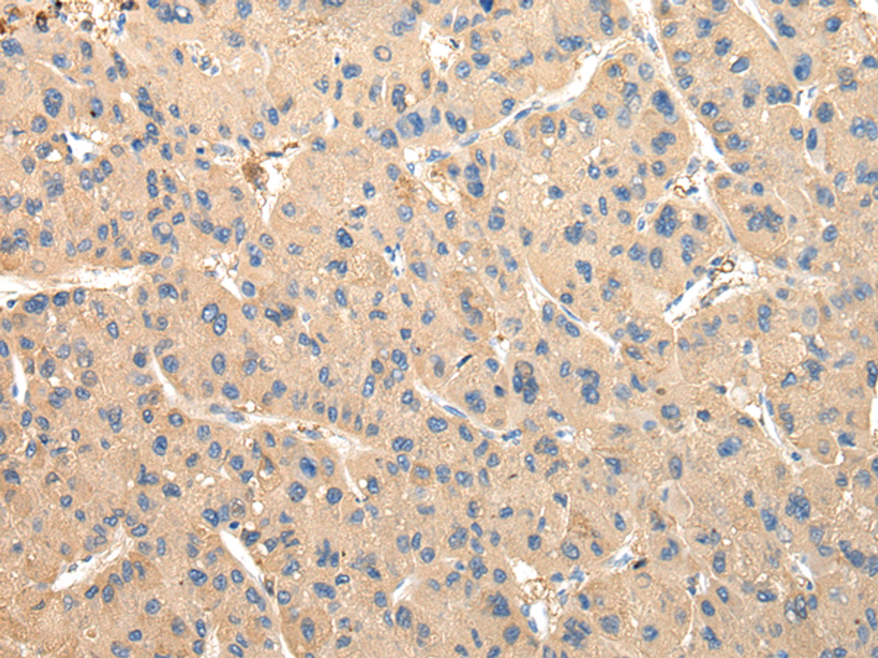 Immunohistochemistry of paraffin-embedded Human liver cancer tissue using DUSP11 Polyclonal Antibody at dilution 1:50