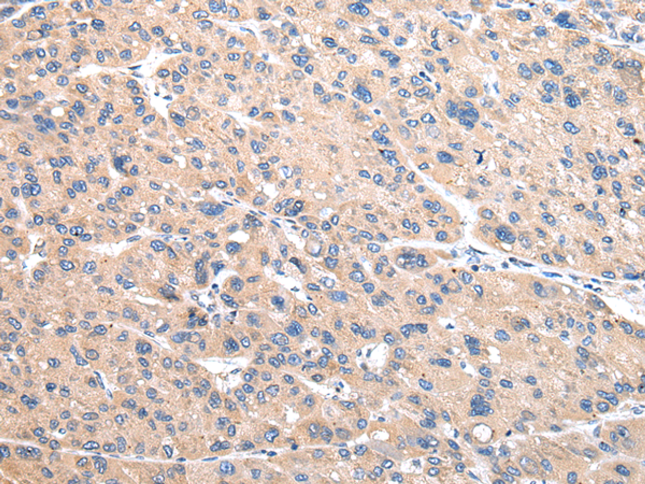 Immunohistochemistry of paraffin-embedded Human liver cancer using VAMP4 Polyclonal Antibody at dilution of  1/30