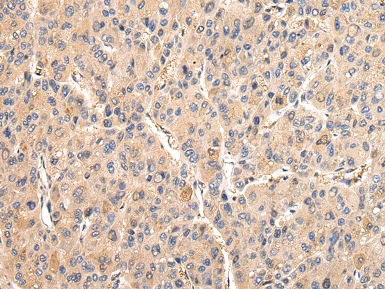 Immunohistochemistry of paraffin-embedded Human liver cancer tissue using VCAM1 Polyclonal Antibody at dilution 1:30