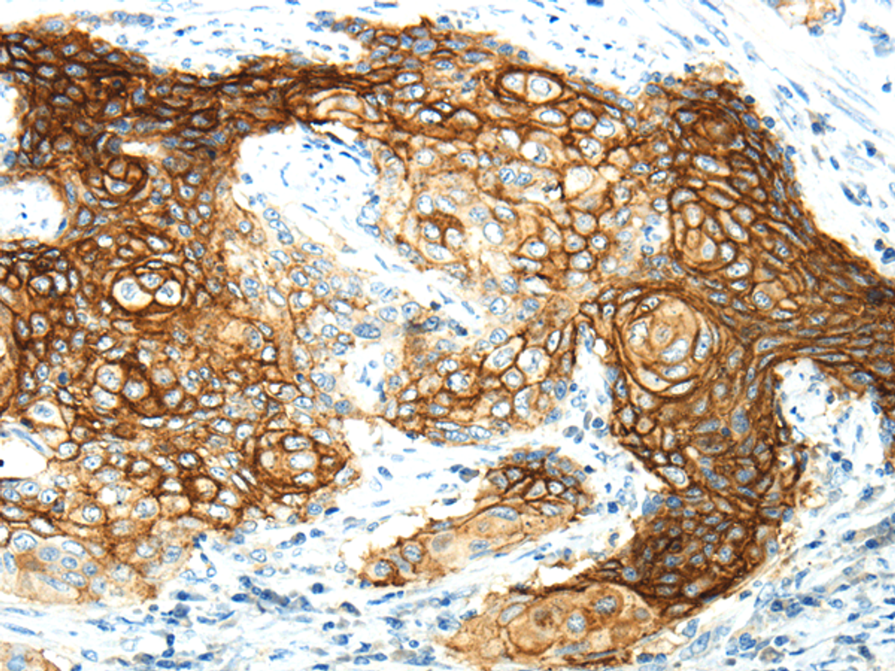 Immunohistochemistry of paraffin-embedded Human cervical cancer using AQP3 Polyclonal Antibody at dilution of  1/30