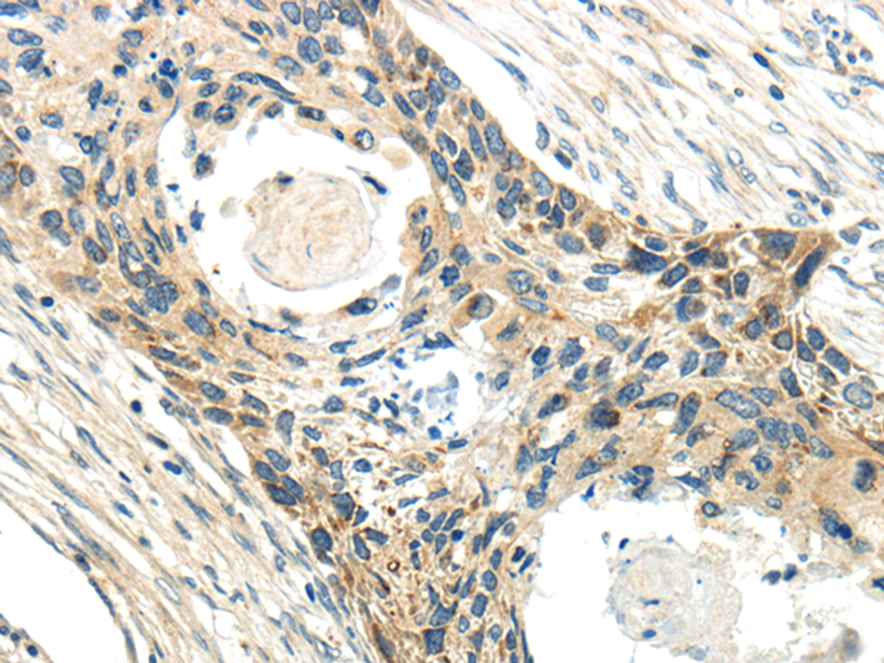 Immunohistochemistry of paraffin-embedded Human esophagus cancer tissue using CCL13 Polyclonal Antibody at dilution 1:40