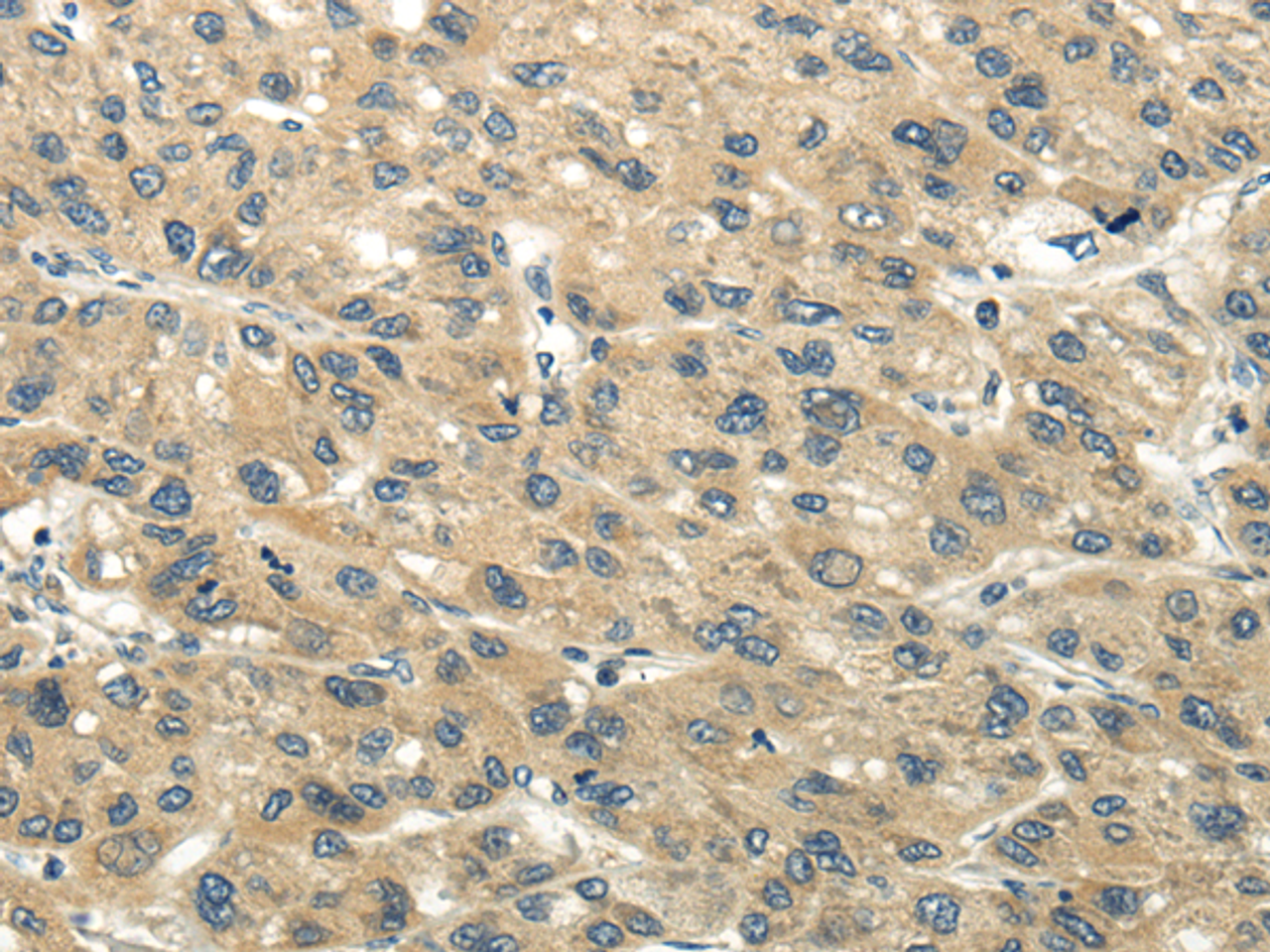 Immunohistochemistry of paraffin-embedded Human liver cancer tissue using CHGB Polyclonal Antibody at dilution 1:40