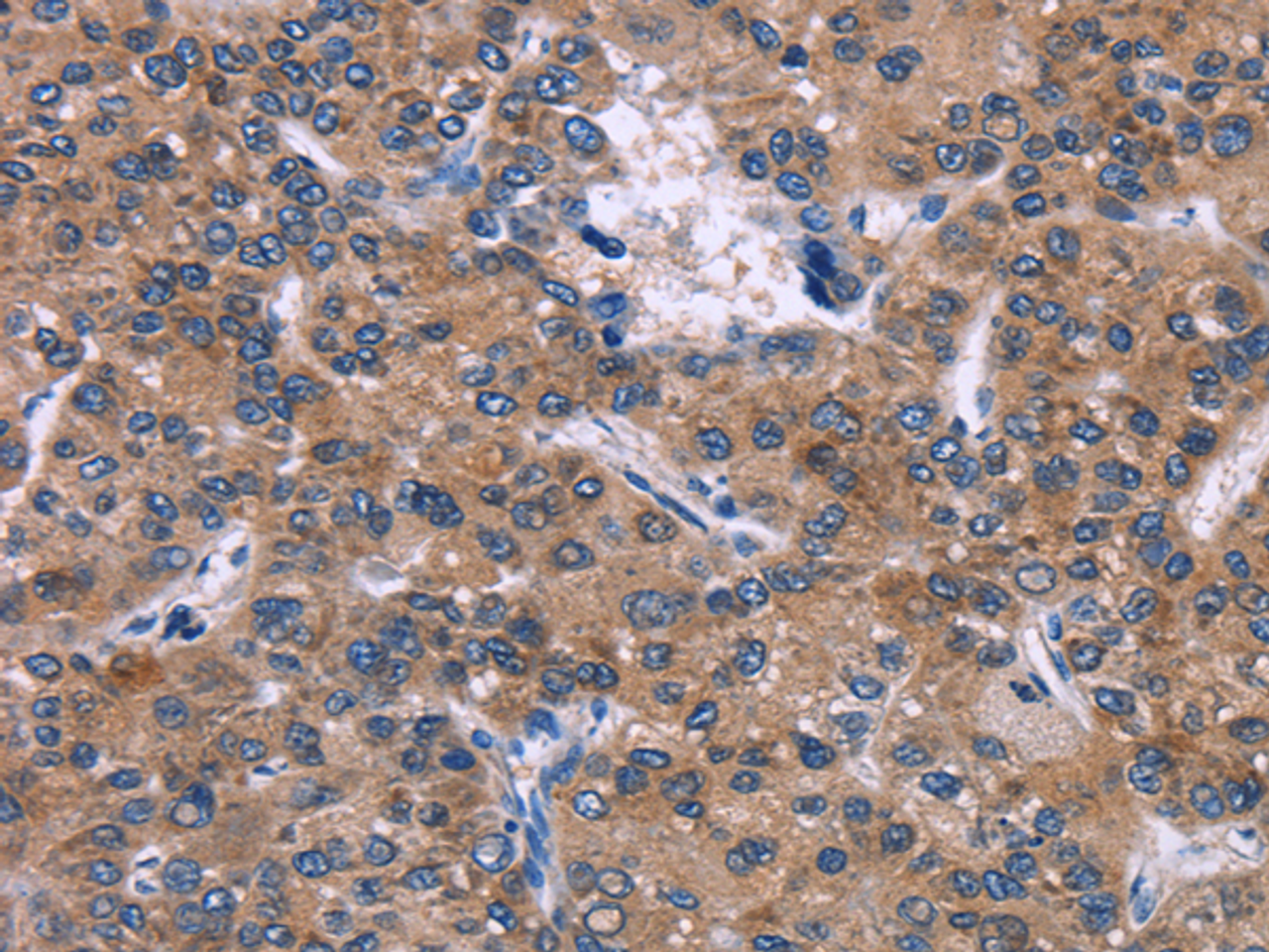 Immunohistochemistry of paraffin-embedded Human liver cancer tissue using SKI Polyclonal Antibody at dilution 1:40